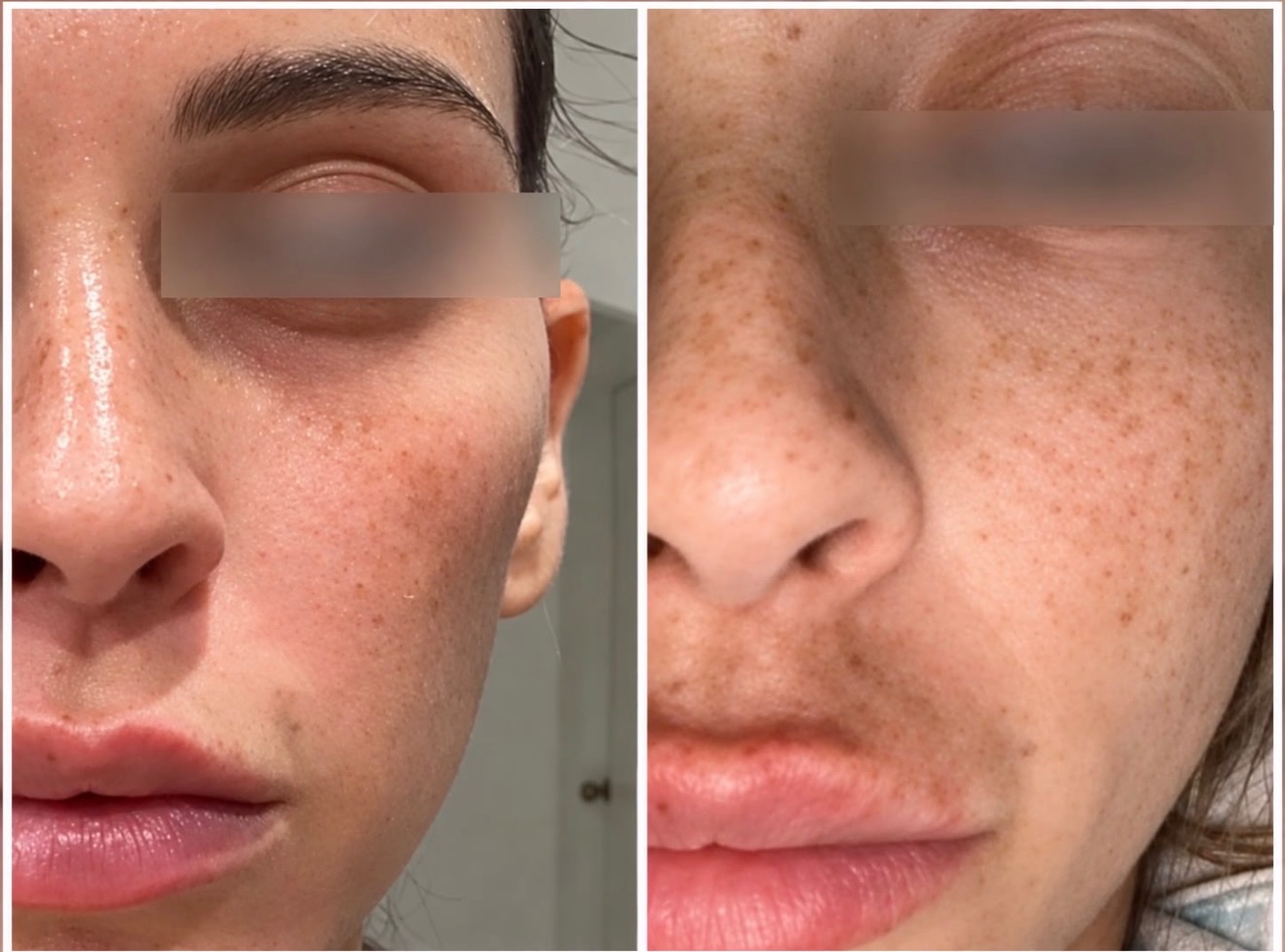 Chemical peel — before treatment