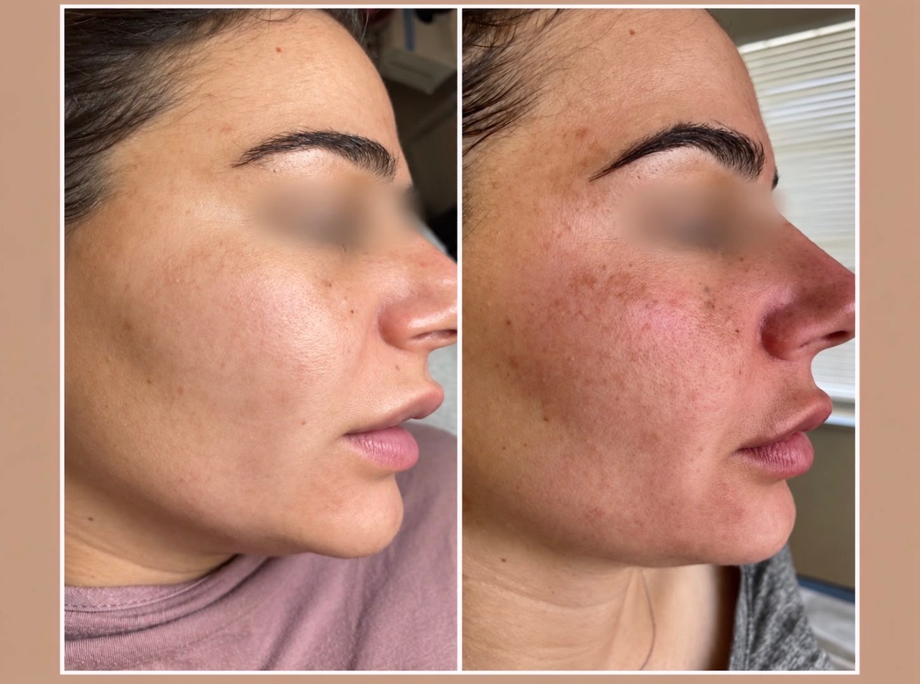 Chemical peel — before treatment