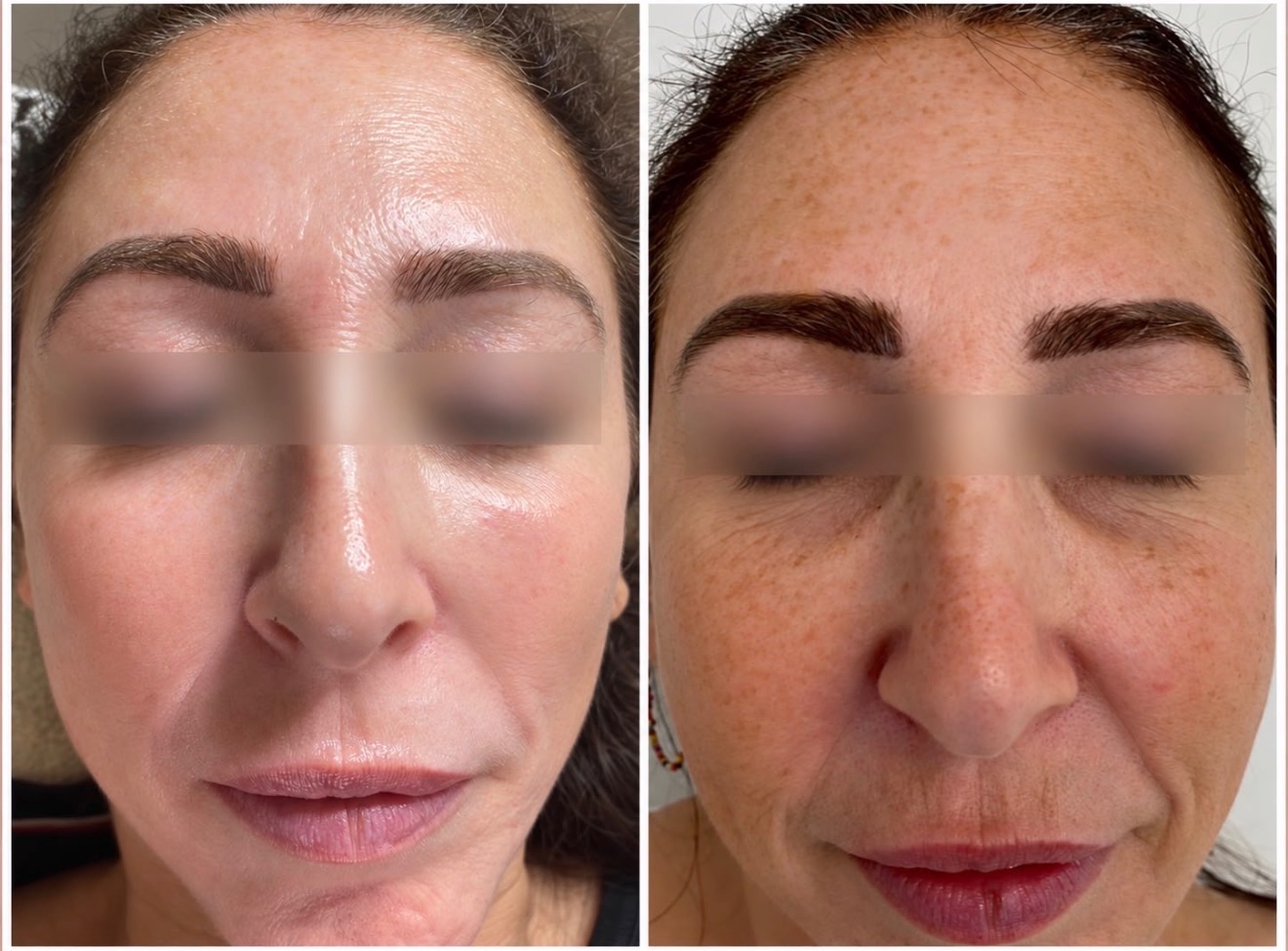 Chemical peel — before treatment