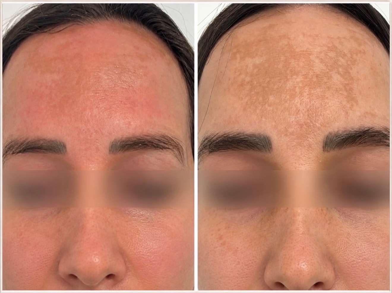 Chemical peel — before treatment