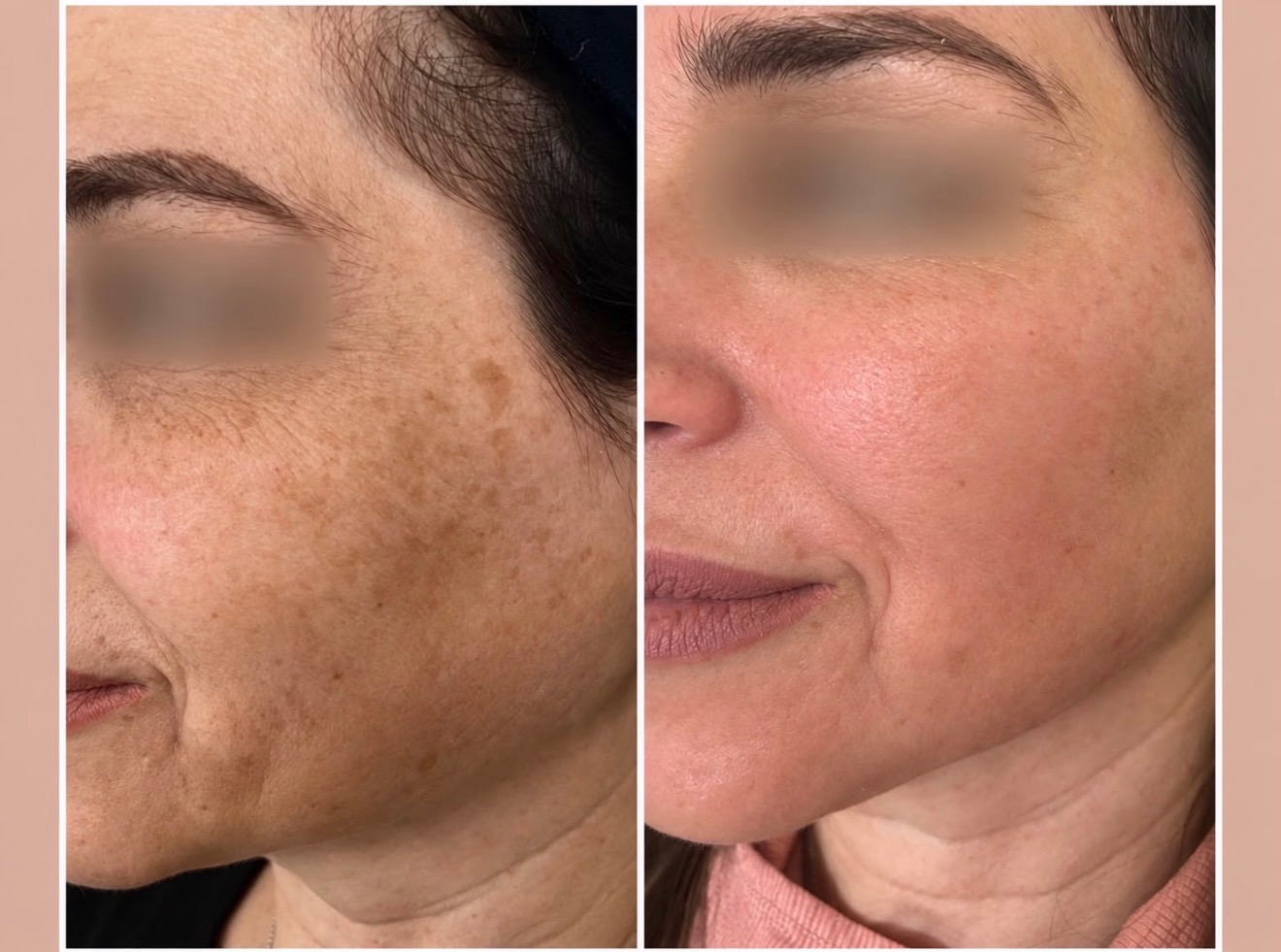 Chemical peel — before treatment
