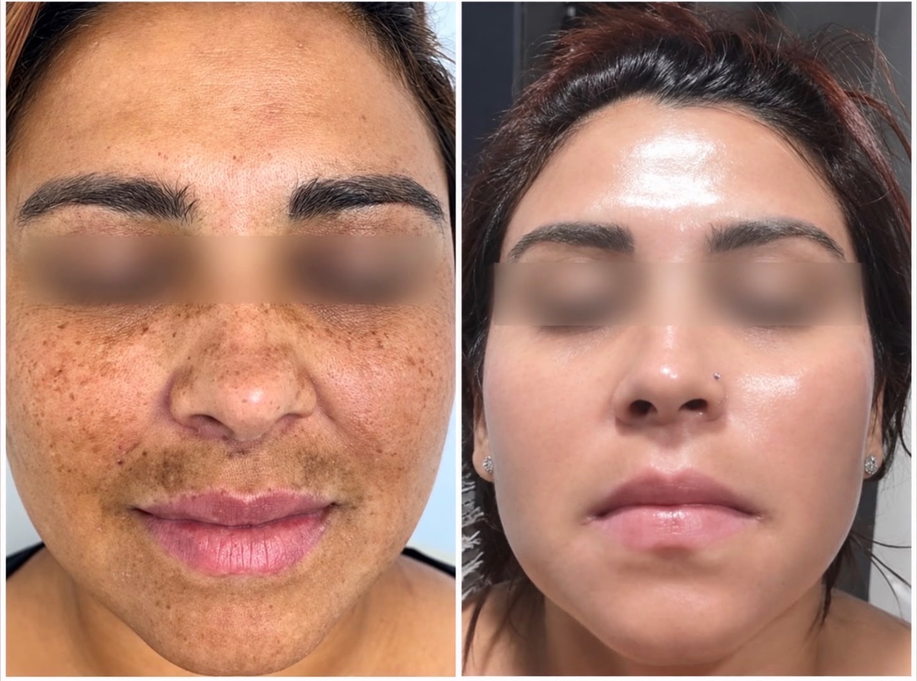 Chemical peel — before treatment