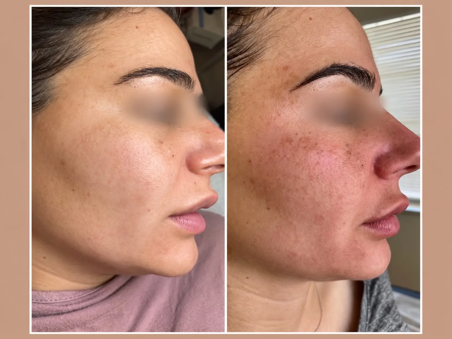 Facial peel result comparison: after on the left, before on the right
