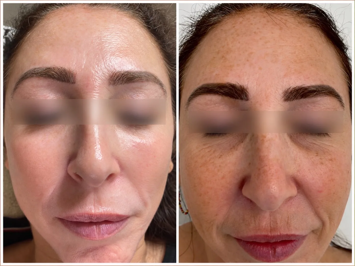 Facial peel result comparison: after on the left, before on the right