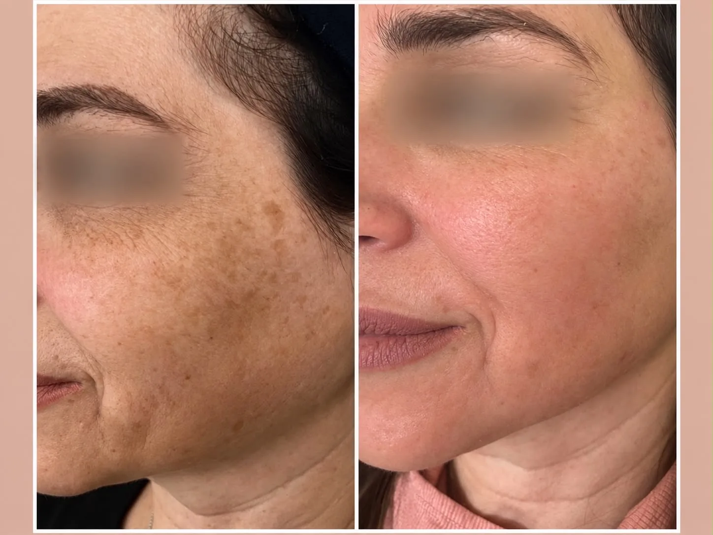Facial peel result comparison: before on the left, after on the right